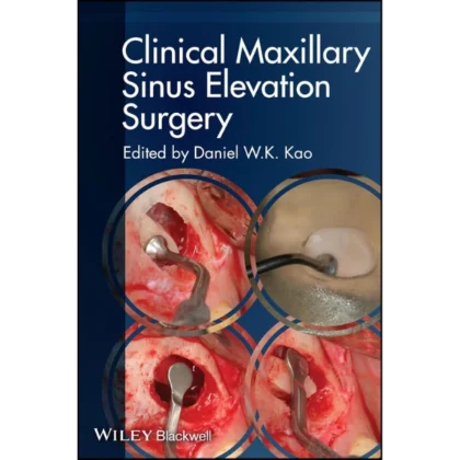 Clinical Maxillary Sinus Elevation Surgery