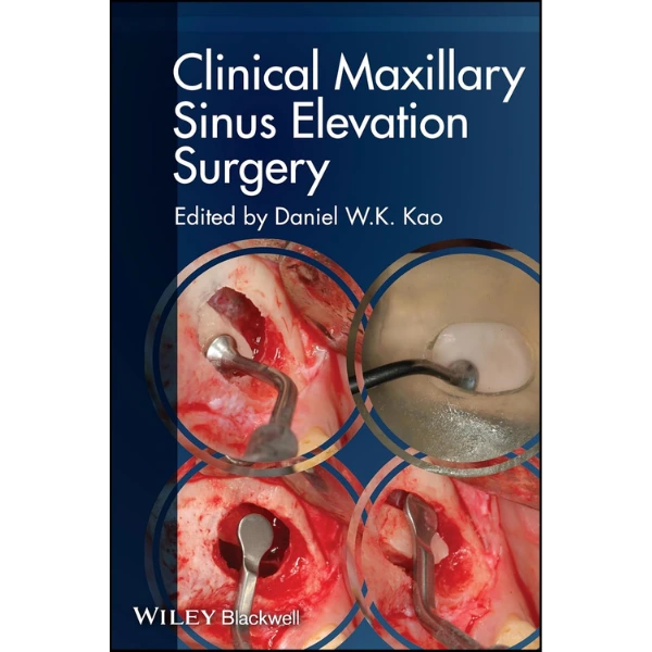 Clinical Maxillary Sinus Elevation Surgery